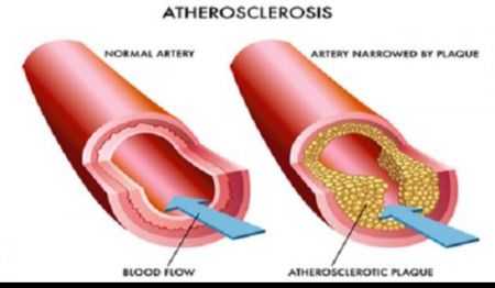 الدهون الثلاثية تُعتبر الدهون الثلاثيّة (بالإنجليز...